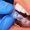 Close up of woman getting dental aligner on her teeth during appointment at dentist's.